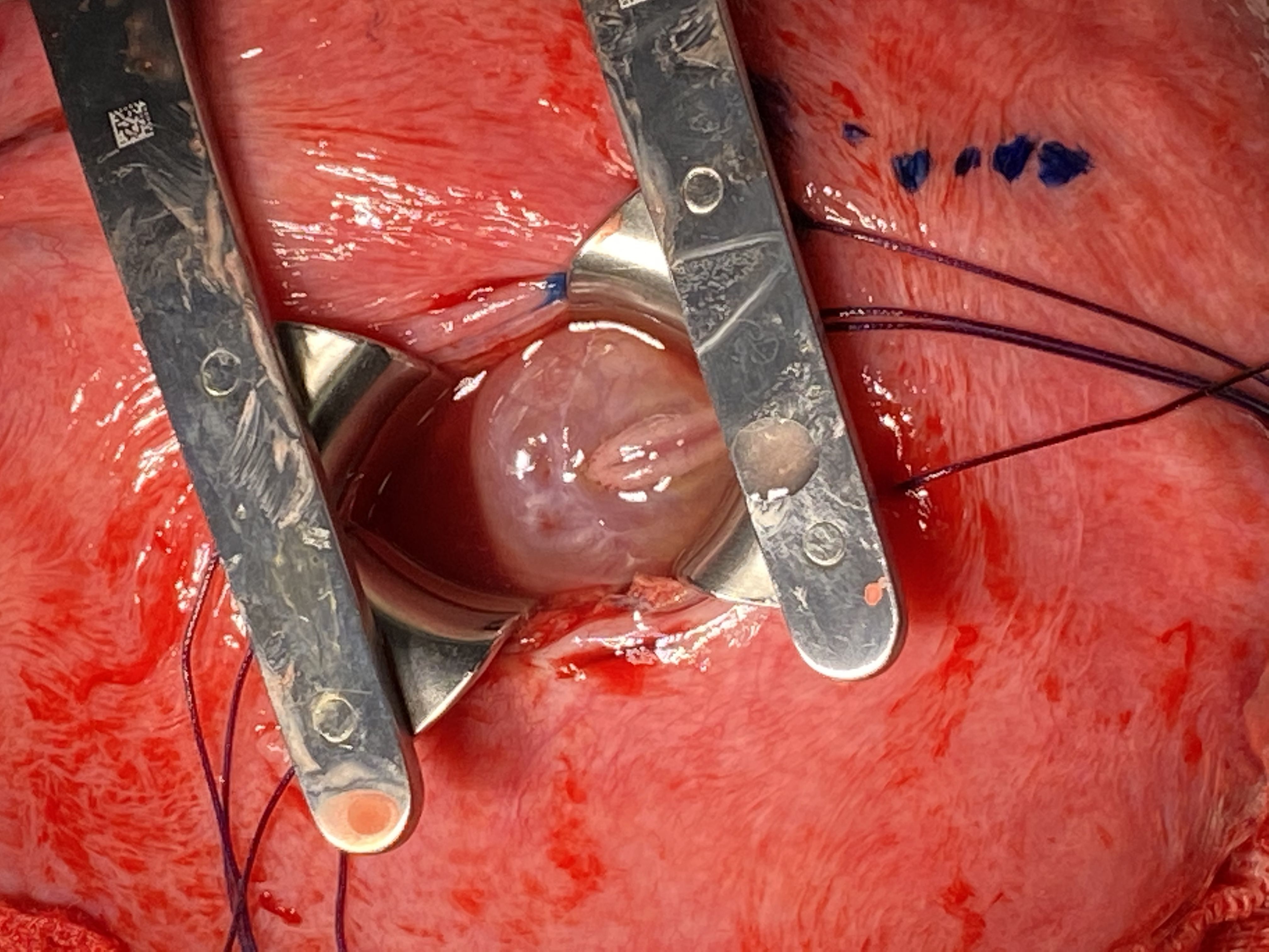 Correção intrauterina da mielomeningocele por minihisterotomia: À esquerda, observa-se a mielomeningocele exposta na incisão uterina (minihisterotomia). À direita, a incisão no útero fechada com aproximadamente 3 cm de tamanho.