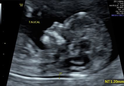 Figura 2: Feto de 12 semanas de idade gestacional em Ultrassom Morfológico de 1º Trimestre em que é possível rastrear a mielomeningocele por meio de marcadores específicos dessa fase.