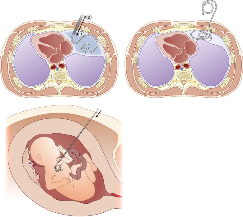 Figura 1: Inserção do dreno no tórax do feto que apresenta derrame pleural – Shunt tóracoamniótico.